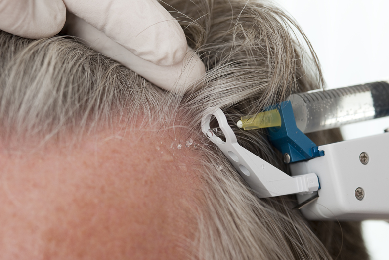 bei Haarausfall ein spezieller Mesoline- Haarcocktail mittels Microneedling oder intracutaner Injektionen in die Kopfhaut eingebracht werden.