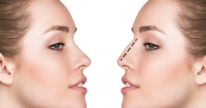 Female face, before and after cosmetic nose surgery isolated on white | Foto: llhedgehogll/ Fotolia