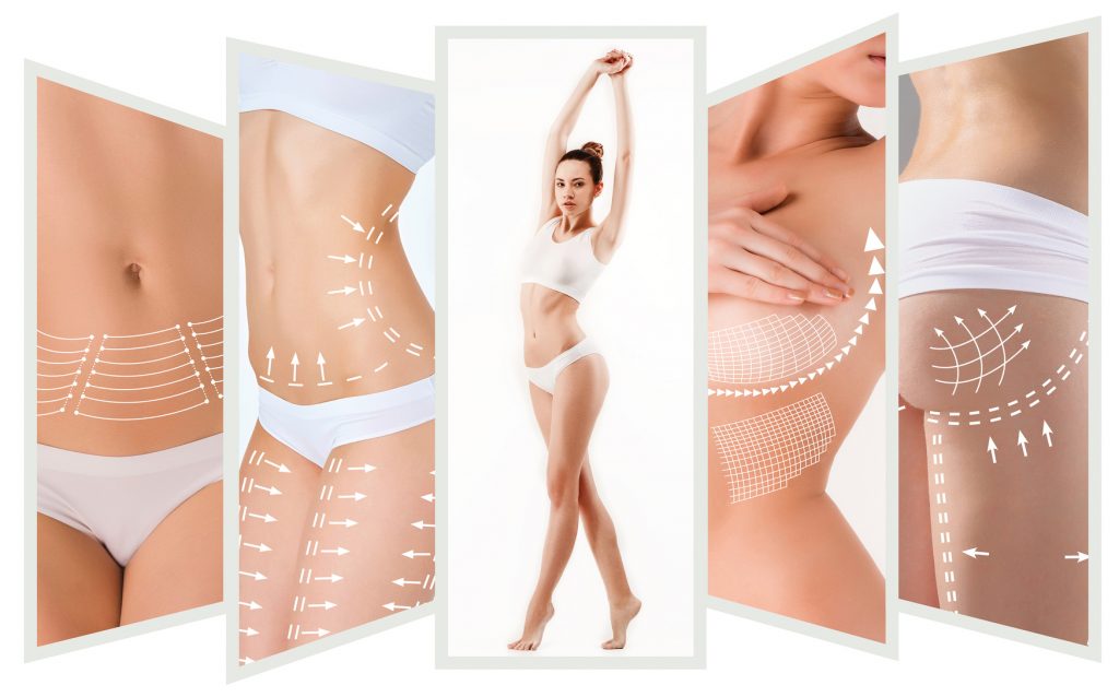 The cellulite removal plan. White markings on young woman body preparing for plastic surgery. Concept of slimming, liposuction, strand lifting | Foto: master1305/ Fotolia