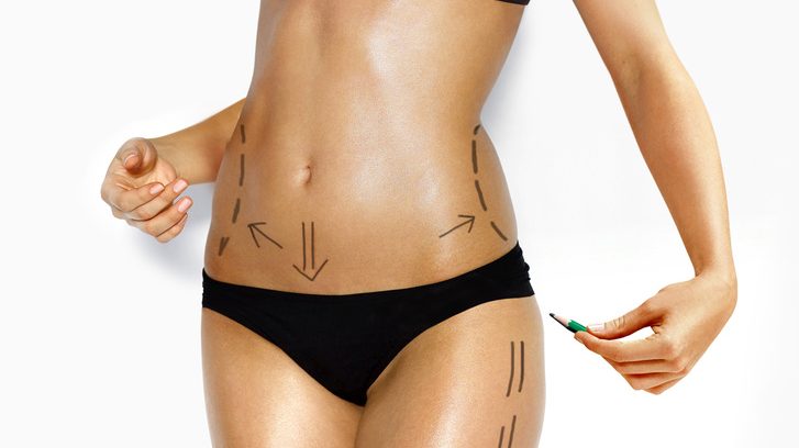 attractive Caucasian woman's abdomen and legs marked with lines for abdominal cellulite correction cosmetic surgery | Foto: Sergiy Serdyuk/ Fotolia